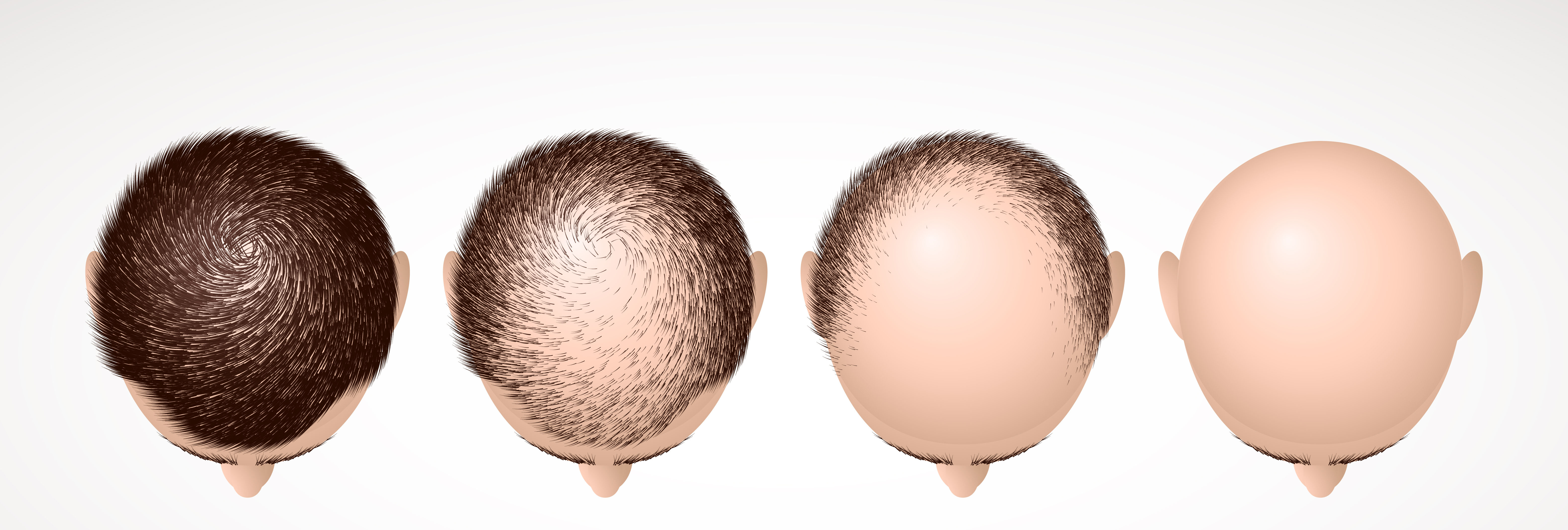 baldness treatment